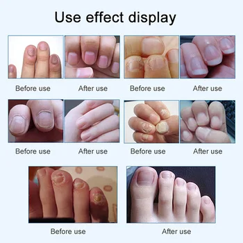 

Nail Fungal Treatment Set Onychomycosis Removal Anti Fungus Toenail Nails Care Repair Liquid 25ml LDO99