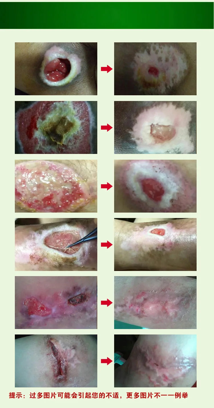 Beste 1PC Kruiden Verwijderen Rotten Myogene Crème Doorligwonden Plakken Behandelen Decubitus Decubituses Decubitus Etterende Wondgenezing