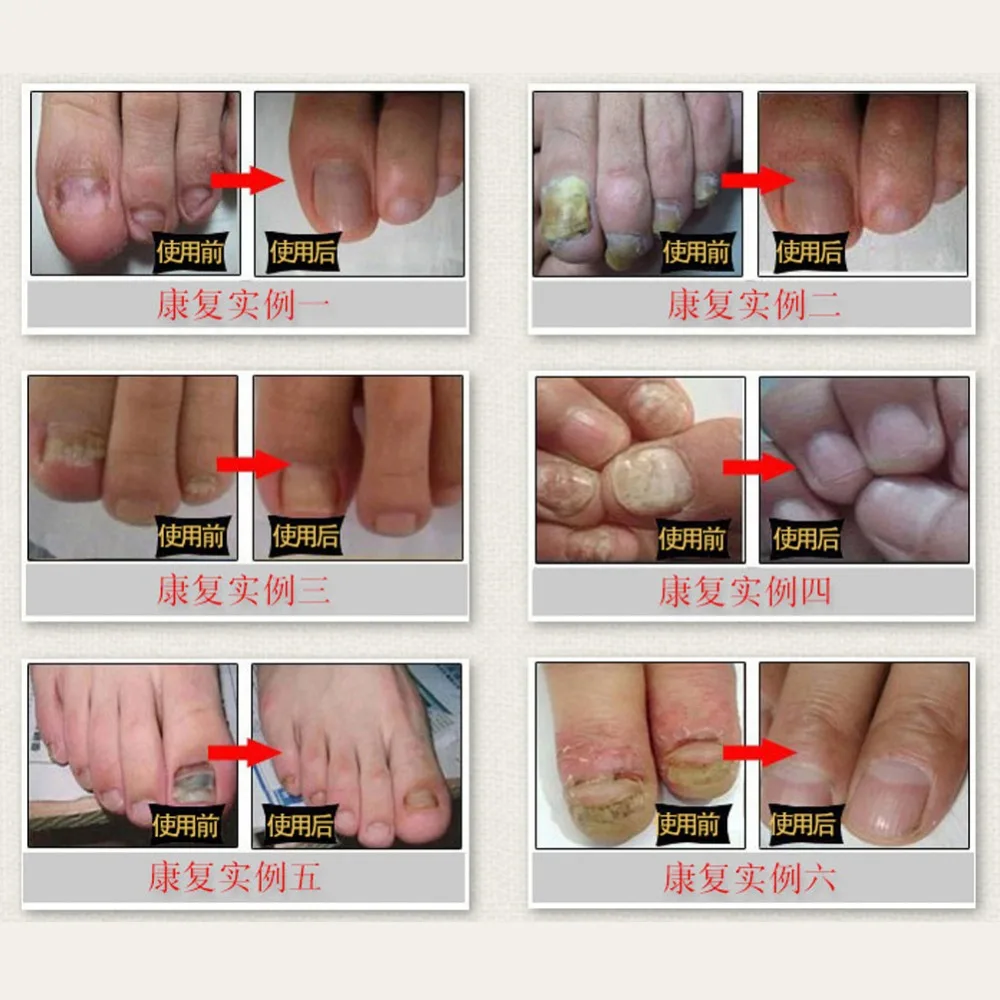 Fungal Nail Treatment Essence Nail and Foot Whitening Toe Nail Fungus Removal Feet Care Nail