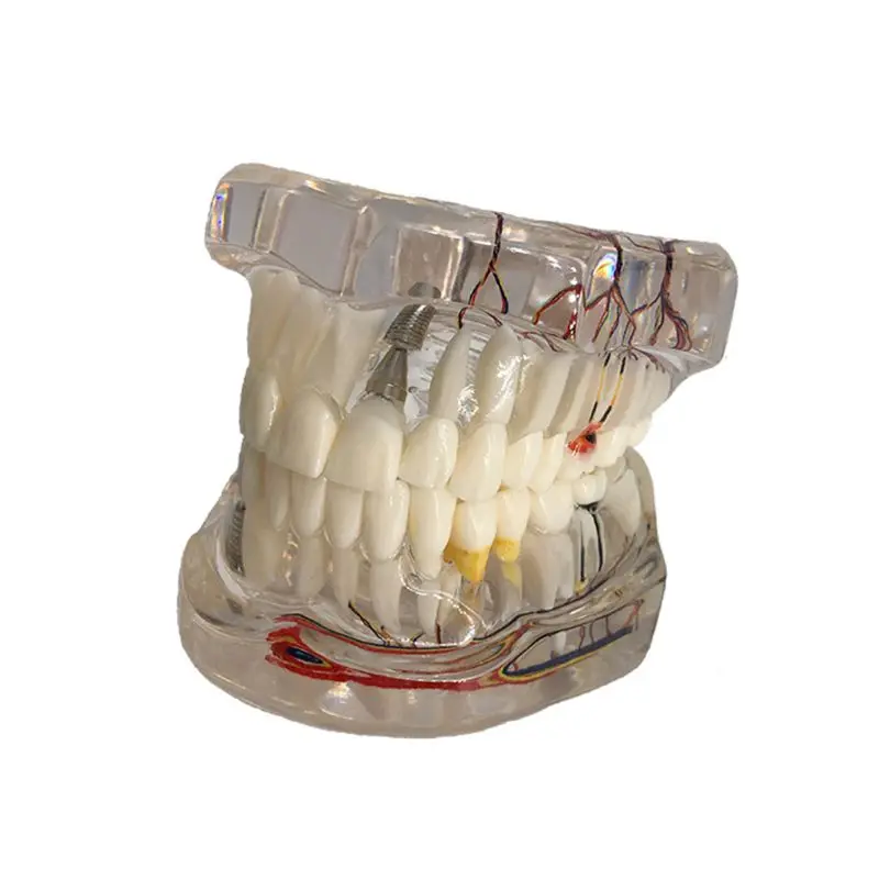 

Dental Disease Implant Teeth Model with Restoration Bridge Tooth Dentist for Medical Science Disease Teaching Study LX9A