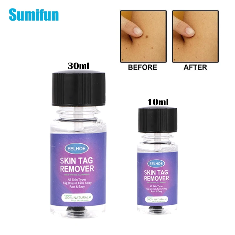 

10/30ml Remover Warts Removal Relief Medical Treatment Meat Corn Flat Wart Antibacterial Liquid Foot Calluses Skin Care Cream