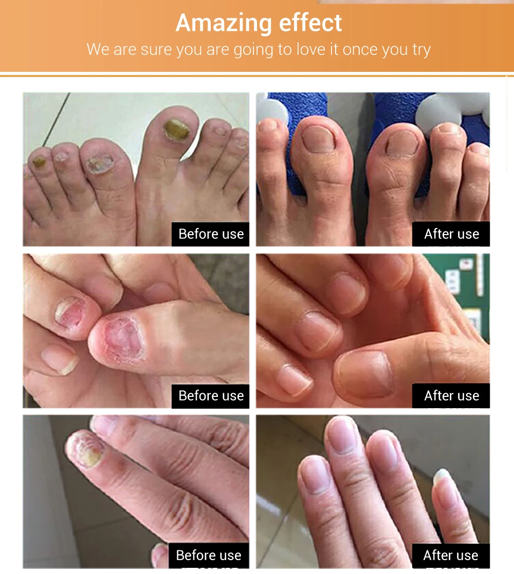 gel anti infecção paronychia onychomycosis mão pé