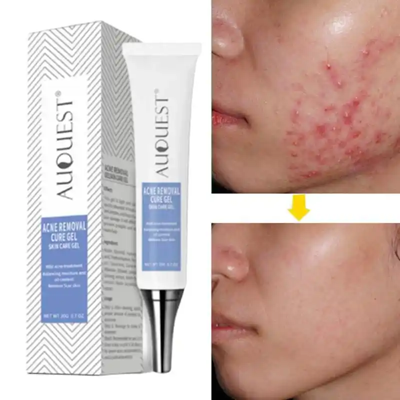 gentle acne treatment