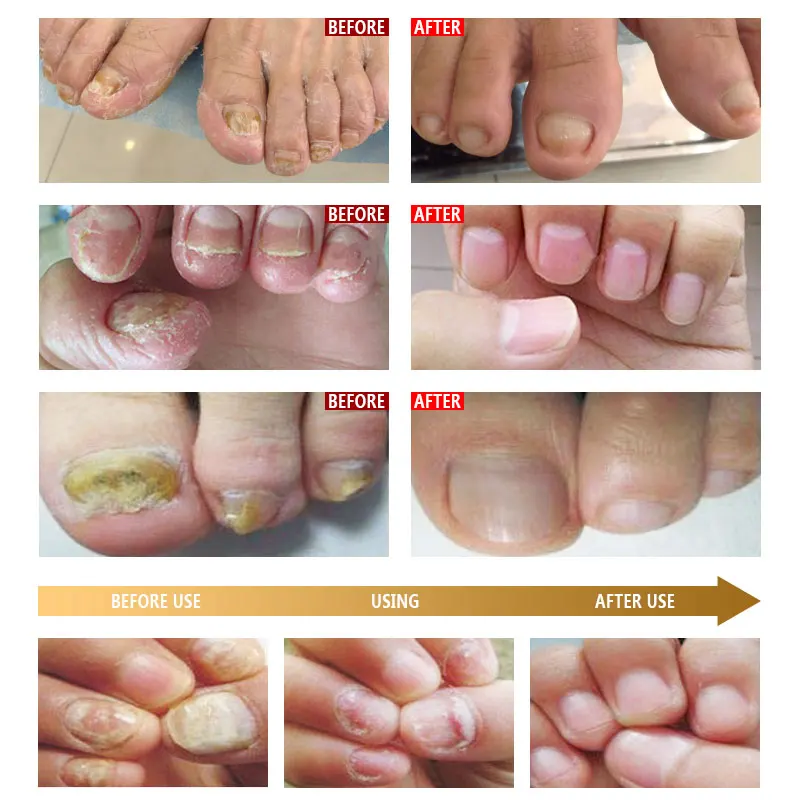 Nail Care Kit ARTISCARE Nail Care Essence Feet Care Nail Serum 20mL