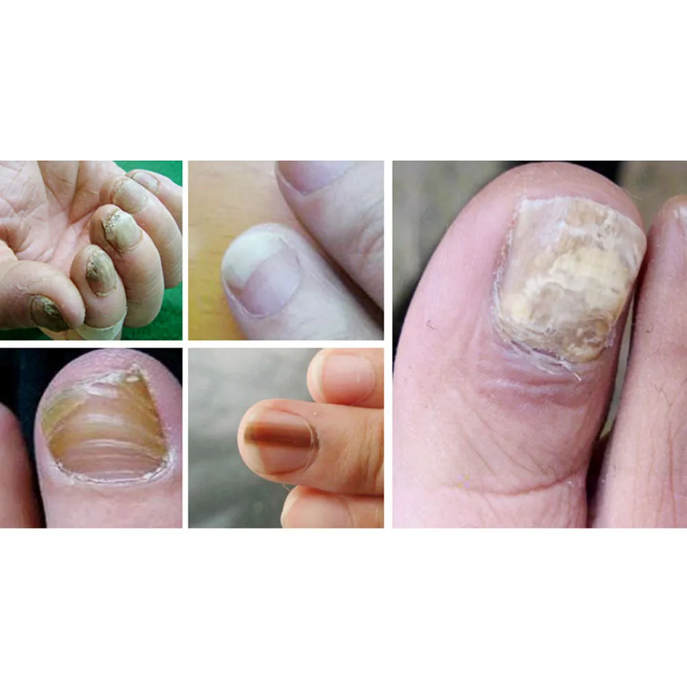 3 шт., ручка для восстановления грибка для ногтей, onychomicosis Paronychia, против грибковой инфекции ногтей, китайская травяная ручка для ухода за ногтями