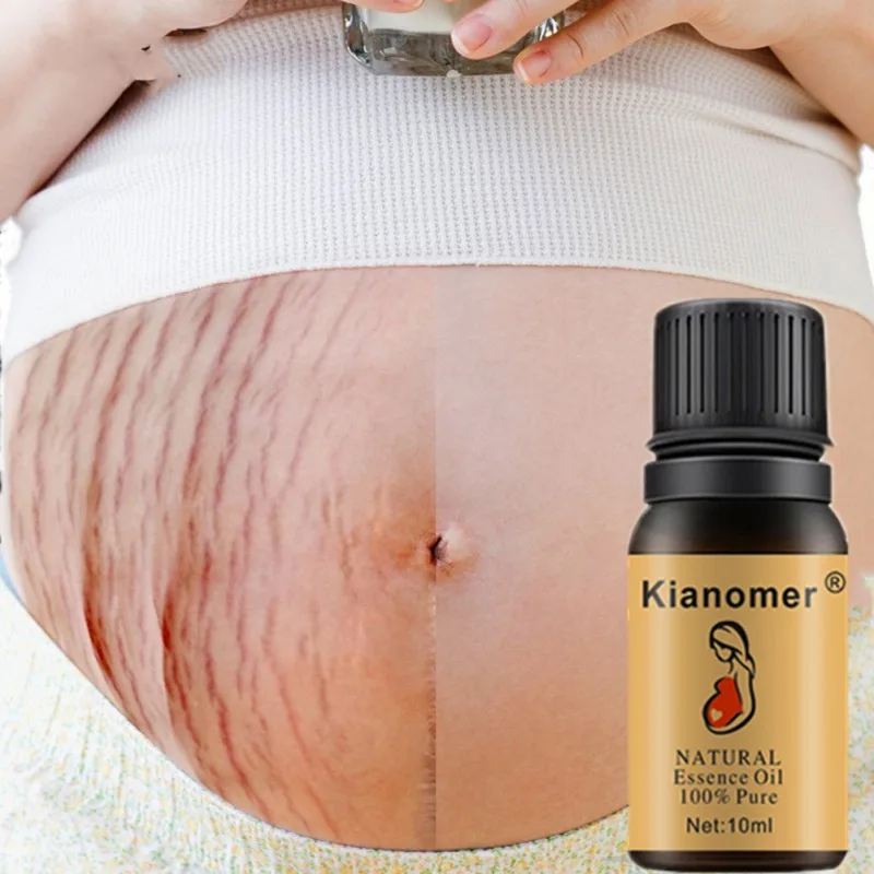 skin bleaching stretch marks