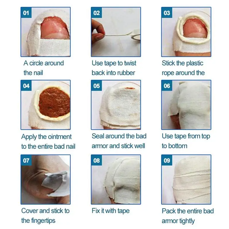 Lanbena nail repair essence от грибка ногтей. паронихия лечение мазь. противогрибковые мази для ног. средство для ногтей. Rtopr ginger antibacterial nail essential oil.