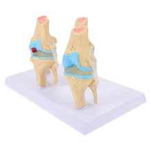 

Human Pathological Knee Joint Model Pathological Knee Joint Display Model