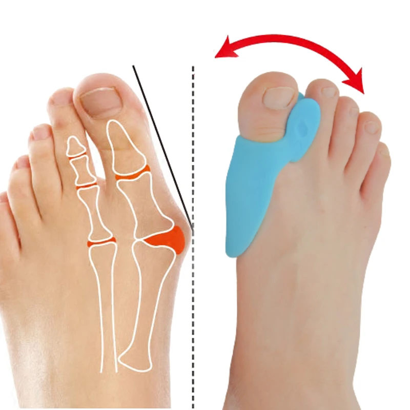 Separador de dedos de martillo Hallux herramienta de cuidado de los pies, Corrector de silicona, ensanchadores, Protector de juanete, alisador de pedicura, 1 2 pares|Separadores del dedo del pie| - AliExpress