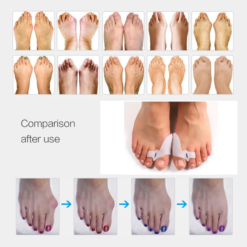 1/2pair Silicone Toe Separator Stretchers Bunion Corrector Straightener Orthopedic Hallux Valgus Correction Pedicure Feet Care