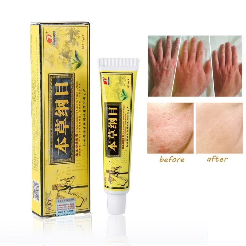 New Herbal Antibacterial AntiItching Cream Chinese Medical Dermatitis