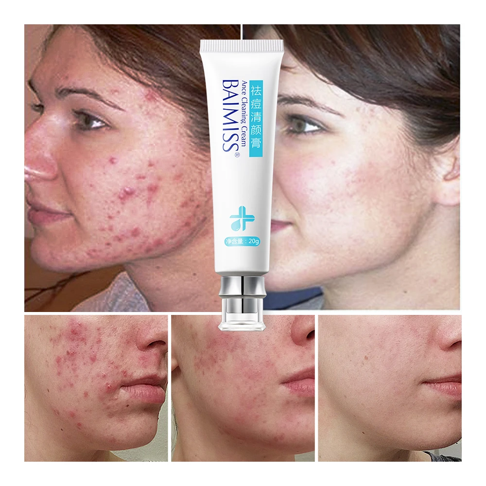 baimiss acne cream
