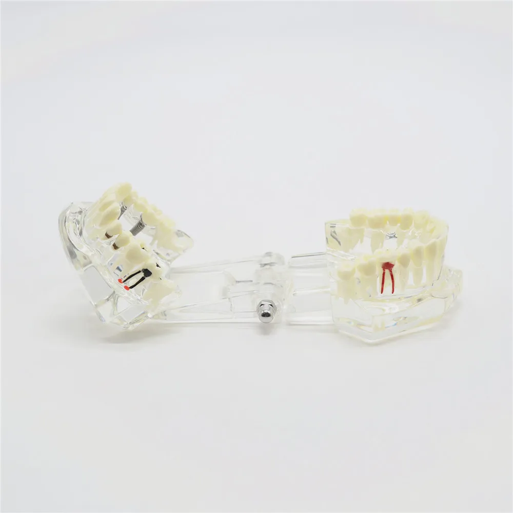 

1set Removable Implant Disease Teeth Model with Restoration Bridge Tooth for Dentist Medical Science Teaching 2001
