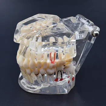 

Dental Accessories high quality teeth model dental implant disease teaching study