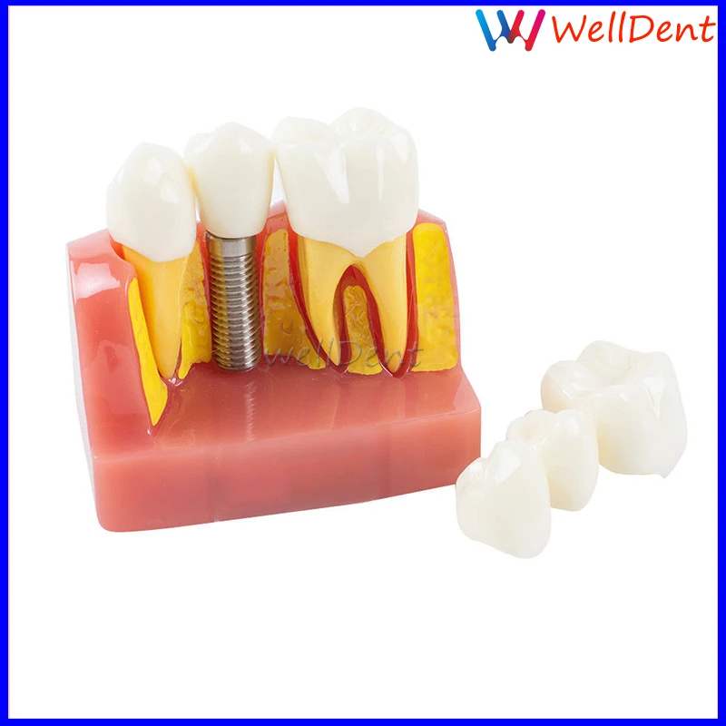 Dental-Implant-Teeth-Model-Analysis-Crown-Bridge-Demonstration-_57