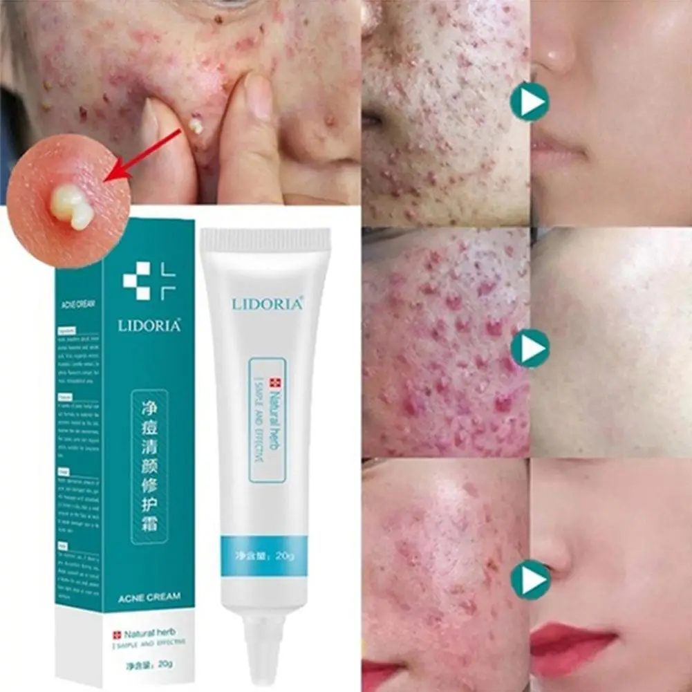 BellyLady 20g limpieza Crema para el acné cara crema de tratamiento antiacné hidratar la nutrición de aceite de Control suave de la piel cuidado de la cara