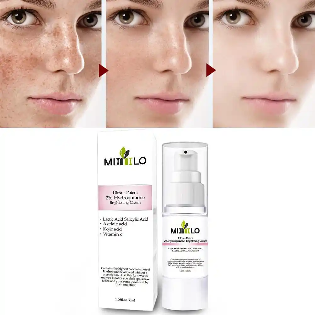 hydroquinone for freckles