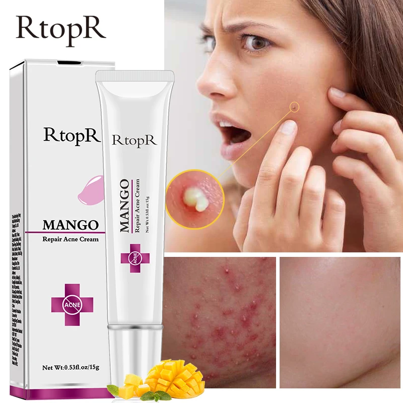 rtopr mango acne cream