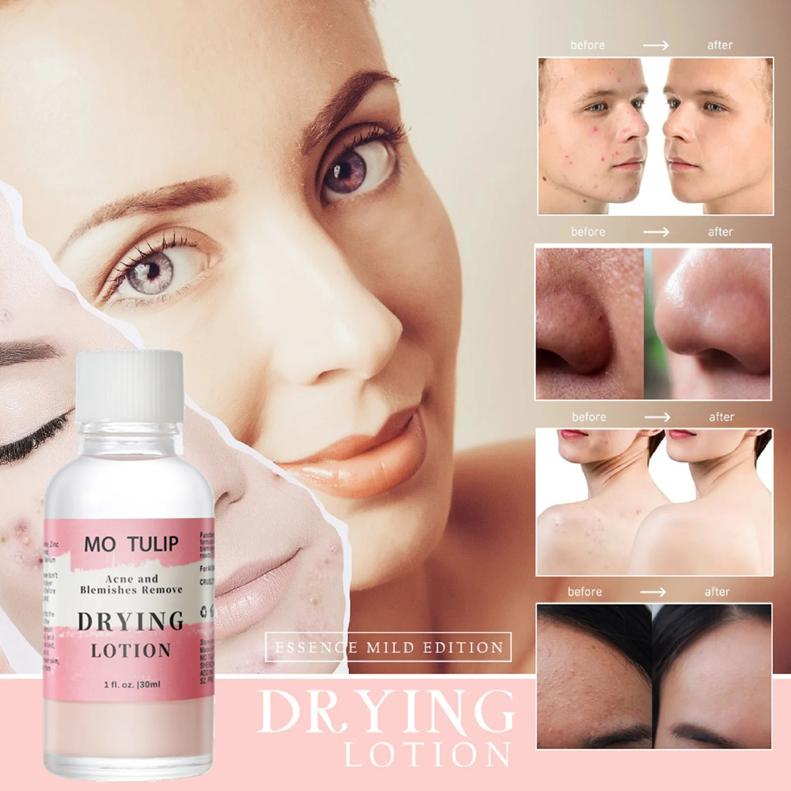 29ml effective Acne Treatment MB Drying Lotion Anti Serum Pimple Blemish Removal | Красота и здоровье