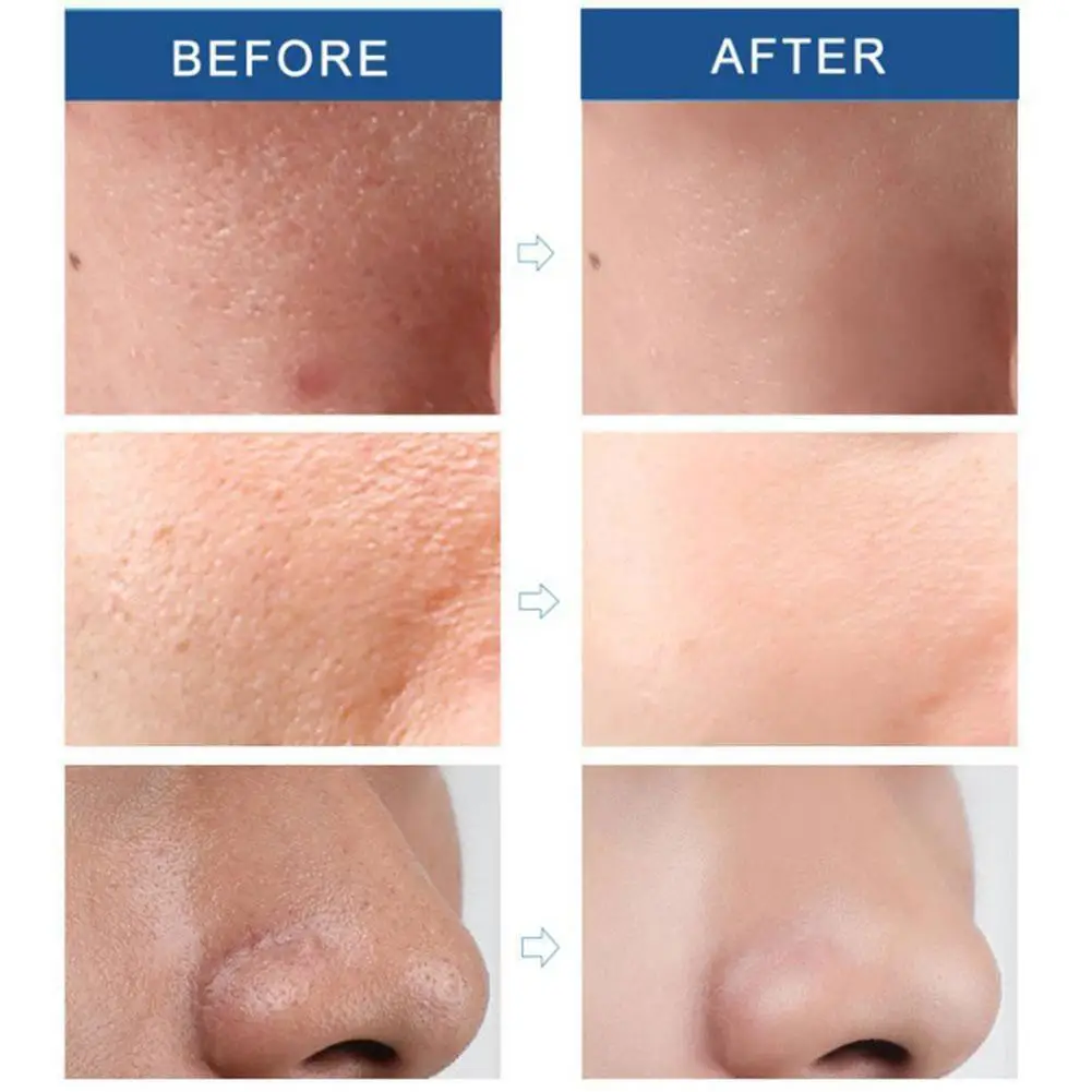 

1 Pcs Shrink Pores Serum Liquid Blackhead Remover Hyaluronic Anti-wrinkle Face Skin Acid Serum Care Moisturizing K5L3