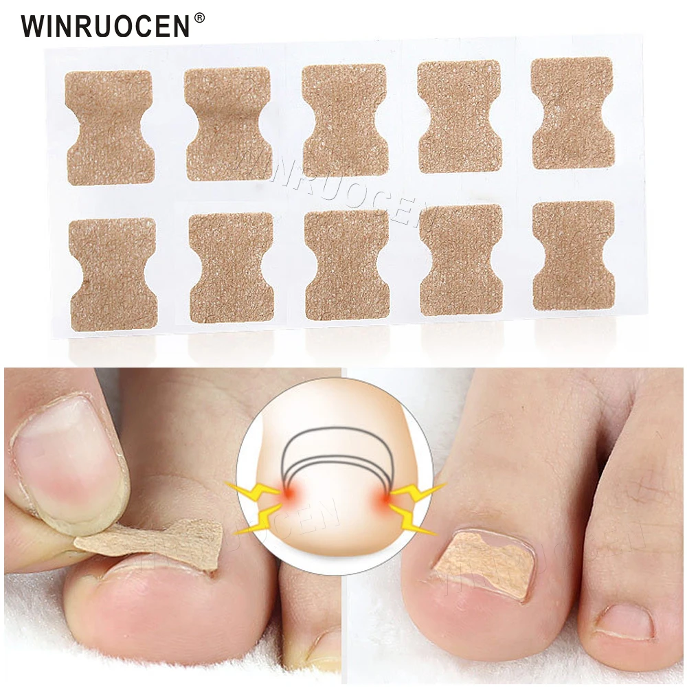 Купить Ingrown Toenail Corrector Sticker Paronychia Treatment Fixer Recover Pedicure Foot Toe Nail Care Tool Glue Free  Обувь | Набор для ухода за обувью (4001081647999)