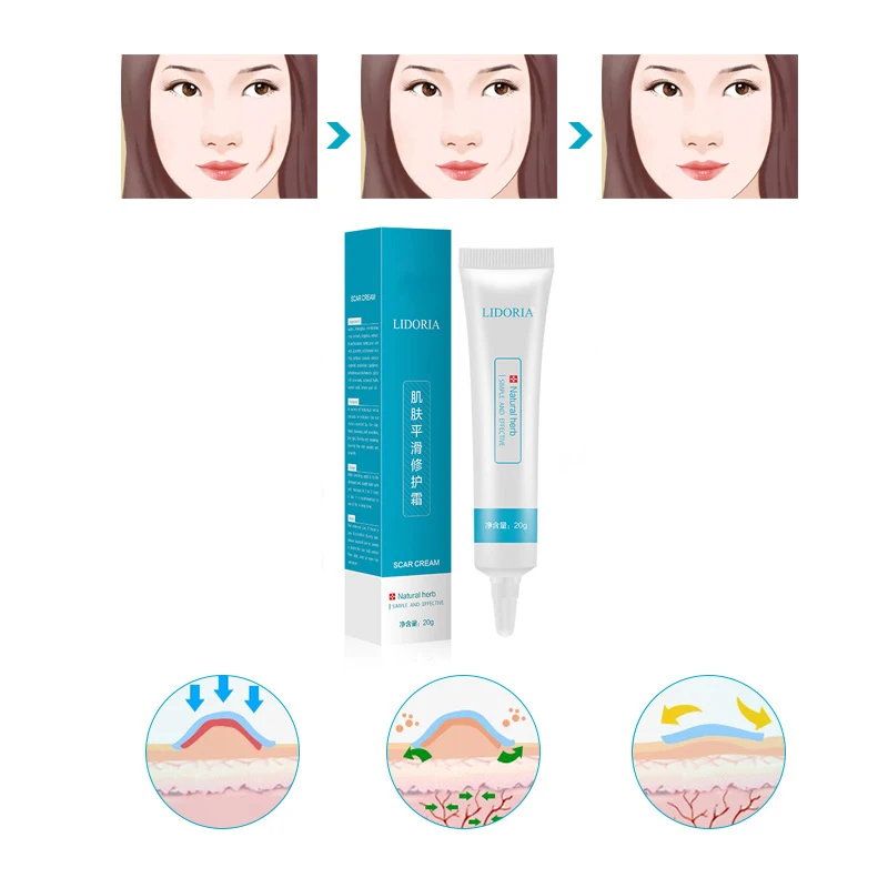 lidoria acne cream
