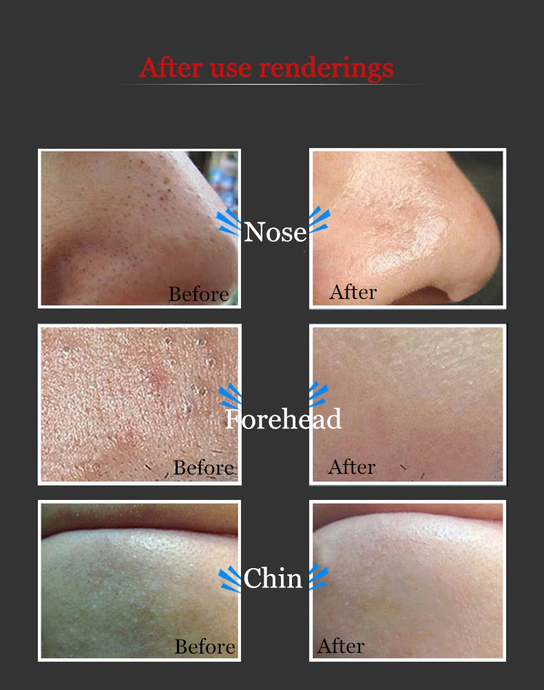 Hankey с бамбуковым древесным углем для Носа Маска blackhead крем для удаления угрей лечение акне пилинг лица маска для удаления пятен уход