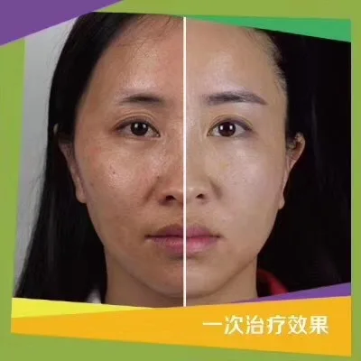 Facial para Clarear Compacta da Ascensão dos Pontos para a Forma da Cara de v o Ácido Hialurónico do Grupo do Rejuvenescimento da Pele Remove Enrugamentos Acne Energia 7 Dicas tatuagem