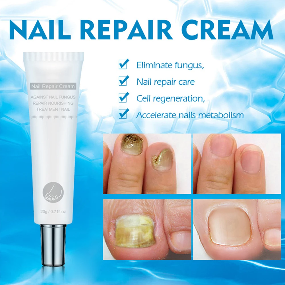 20g Nail Fungus Treatment Cream Onychomycosis Paronychia Anti Fungal Infection Kills Bacteria And | Красота и здоровье