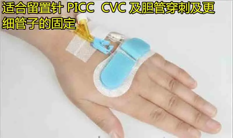 10 шт. PICC ЦВК-катетер фиксация ультра-тонкий катетер фиксация устройства билиарной дренажной трубки фиксированная Стерильная применение