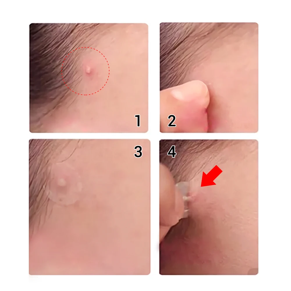 Патчи от акне LANBENA Acne Pimple Patch 28шт.|Средства для ухода и маски| |