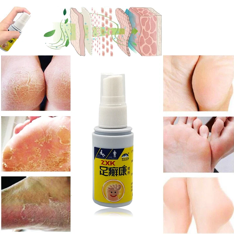 足癣康详情1
