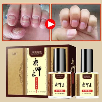

10ml+10ml Natural Nail Fungus Solution Sterilization Relieve Itching Speed Up Nail Growth Antifungal Solution Long Lasting