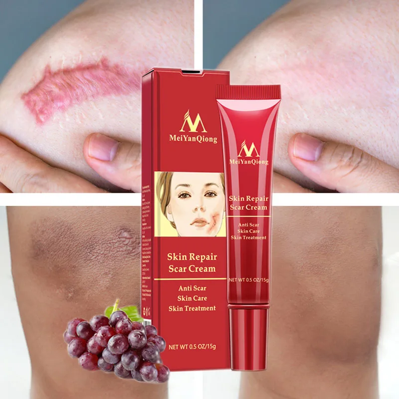 

Acne Scar Removal Face Cream Acne Spots Acne Pigmentation Corrector Whitening Cream Anti Scar Stretch Marks Repair Gel Skin Care