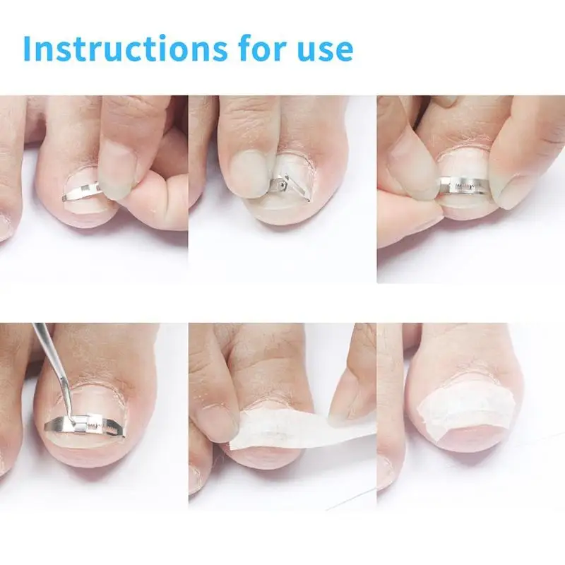 Metal Ingrown Toe Nail Correction Wire Fixer Pedicure Paronychia Recover Toenails Corrector Foot Care Tool