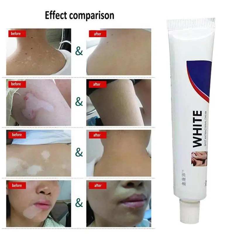 white spots on face ointment