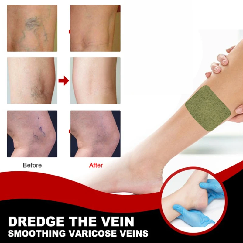 12Pcs/bag Varicose Veins Patch Remove Angiitis Dilated Vasculitis Spider Legs Chinese Medical Plaster Improves Blood Circulation pain relief patch blood sugar patch anti cough plaster urine leakage patch