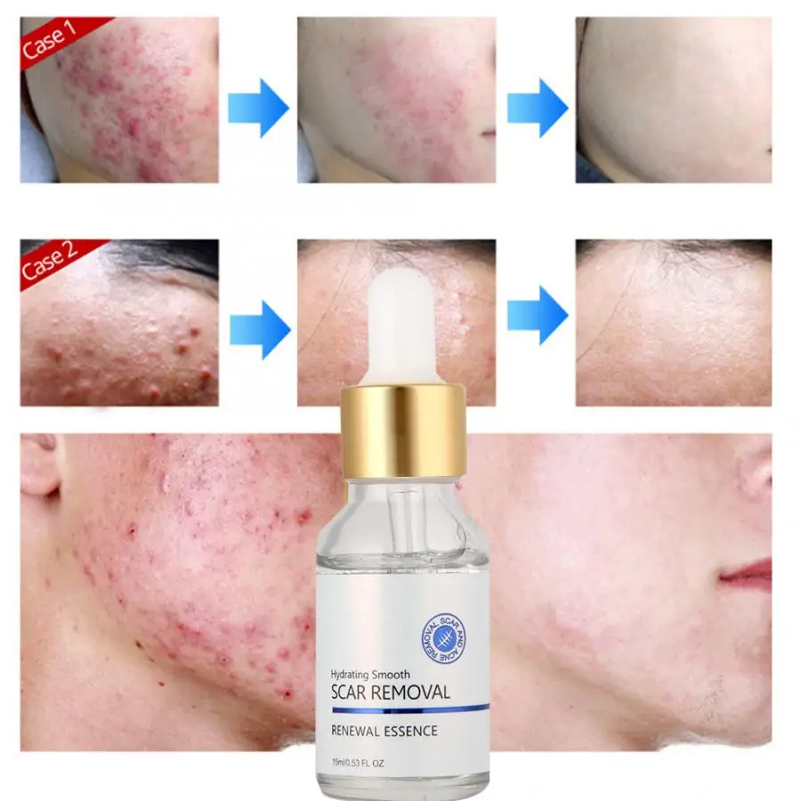 Laser Hair Removal Machine 15ml Anti Acne Face Serum Face Lifting Skin Care Acne Removal Treatment Face Cream Jade Roller
