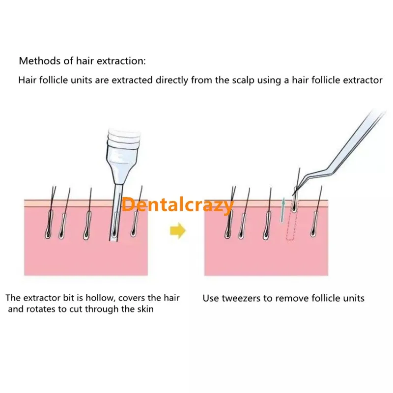 Hair transplant Punch Size 0.8 MM 0.9MM 1.0MM Hair Transplant tool Hair loss Treatment Hair transplant Punch Size 0.8 MM 0.9MM 1.0MM Hair Transplant tool Hair loss Treatment