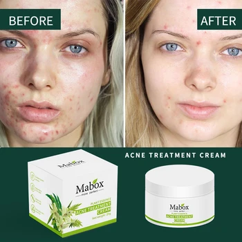 

MABOX 20g Acne Treatment Blackhead Remova Anti Acne Cream Oil Control Shrink Pores Acne Scar Remove Face Care Whitening DropShip