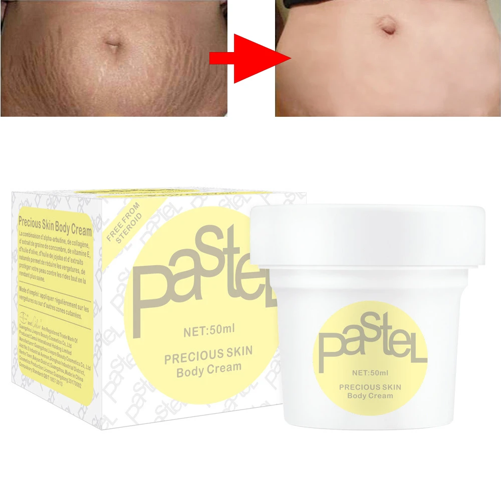 cream for striae gravidarum
