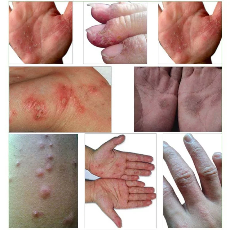 Psoriasis Cream Skin Care Dermatitis Eczematoid Eczema Ointment Treatment Anti Fungal Chinese Herbal Body Psoriasis Cream