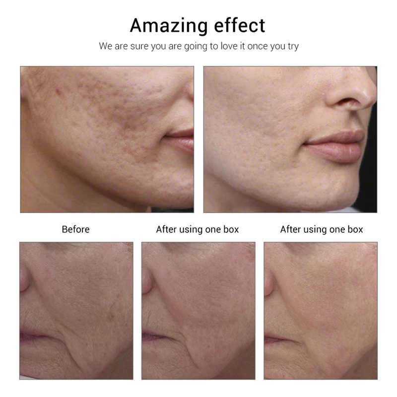 5/8/10/90Pcs Vitamin E Essence Spot Acne Remove Moisturizing Cream Anti Aging Whitening Cream Serum Anti-Wrinkles Face Skin Care 5/8/10/90Pcs Vitamin E Essence Spot Acne Remove Moisturizing Cream Anti Aging Whitening Cream Serum Anti-Wrinkles Face Skin Care
