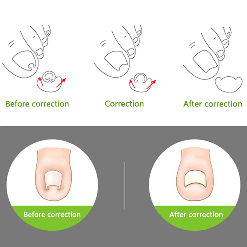 1pc Useful Ingrown Nail Foot Correction Tool Pedicure Toenail Fixer Foot Nail Care Tool Orthotic Nail Corrector Pedicure Tool