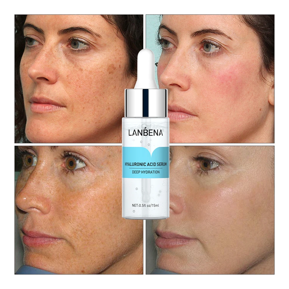 hyaluronic acid serum causing breakouts