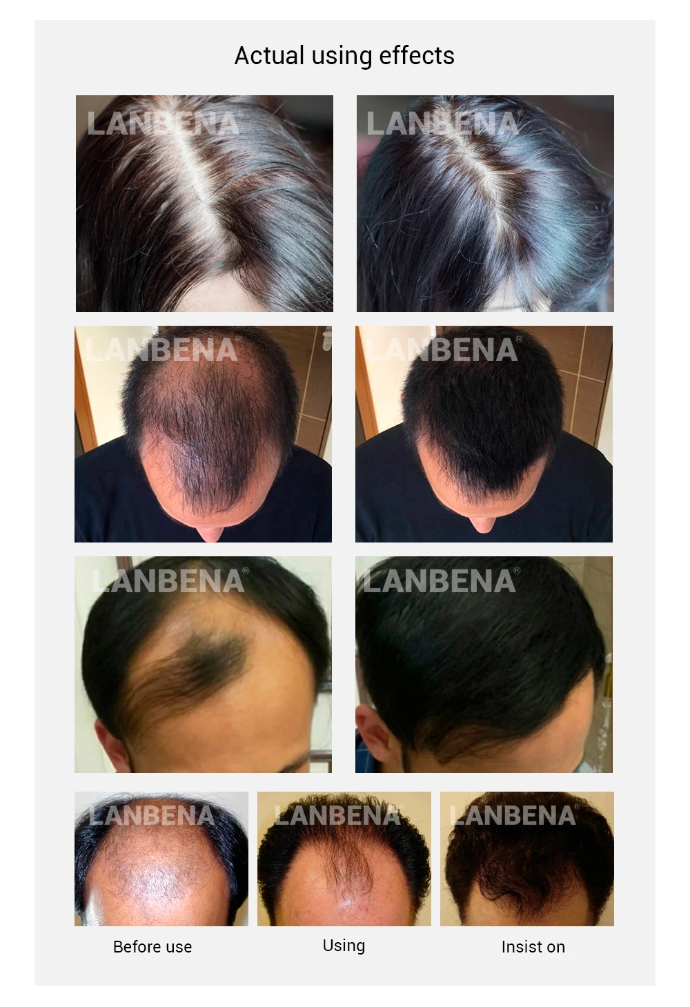 LANBENA эссенция для роста спрей продукт для предотвращения облысения укрепление против выпадения питают корни легко носить Уход за волосами