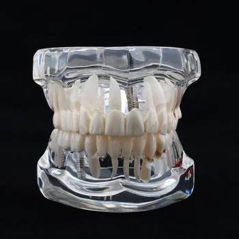 

Dental Display Model Dentist Clinic Stomatologist Research Model Transparent Resin Research Dental Structure Repair Correction