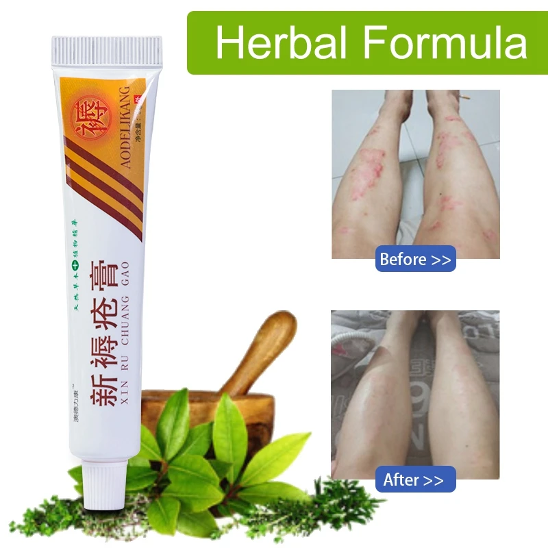 1pcs Bedsore Anointed Ointment Analgesic Cream Bedsores Paste