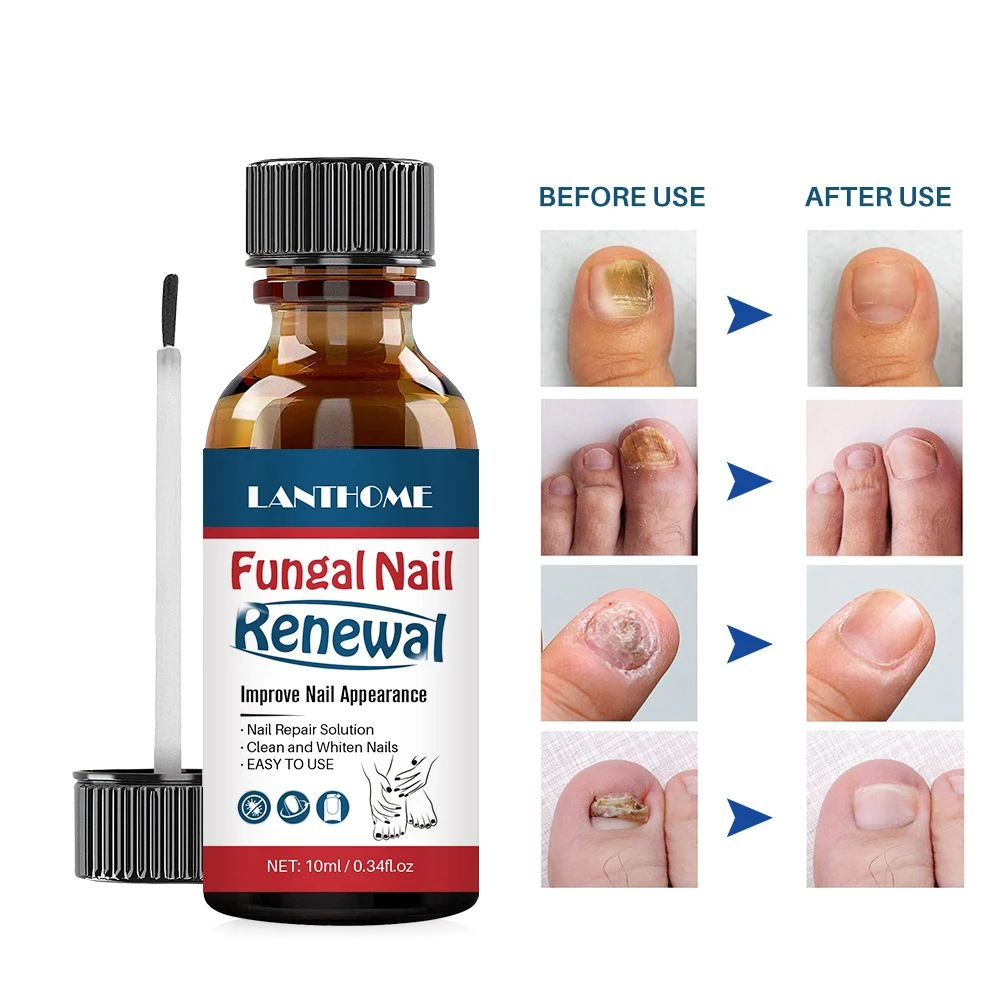 10ml Fungal Nail Renewal Nail Toenail Repair Solution Clean Whiten Nail