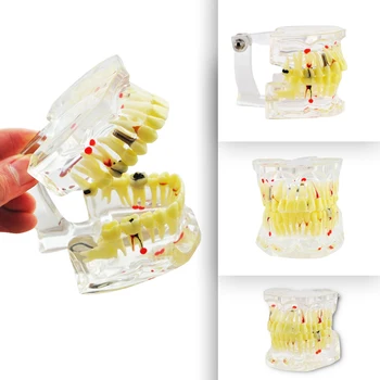 

Dental Study Tooth Transparent Adult Pathological Teeth Model